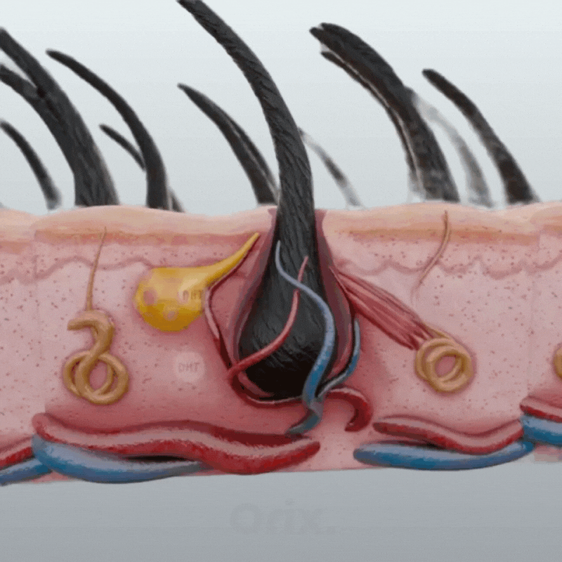 Illustration de follicules pileux stimulés par le sérum Orix